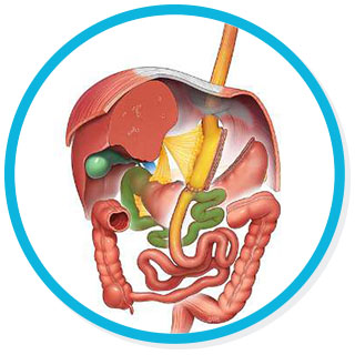 Bypass Gástrico de una anastomosis (BAGUA)