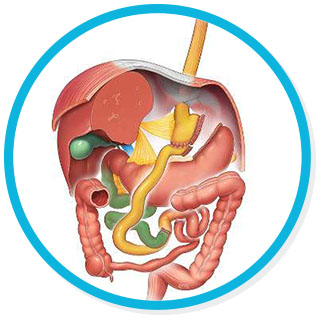 Bypass Gástrico Clásico o en Y de Roux